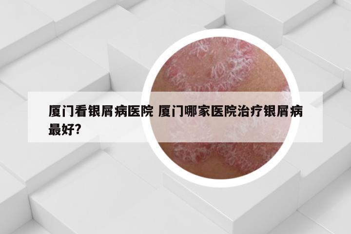 厦门看银屑病医院 厦门哪家医院治疗银屑病最好?