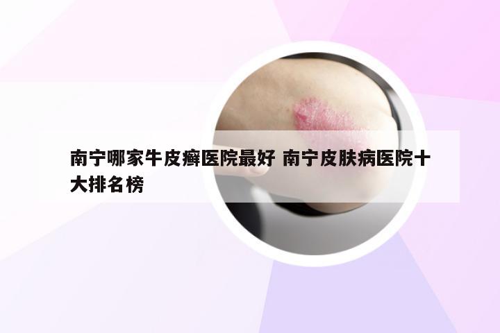 南宁哪家牛皮癣医院最好 南宁皮肤病医院十大排名榜