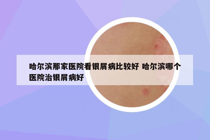 哈尔滨那家医院看银屑病比较好 哈尔滨哪个医院治银屑病好