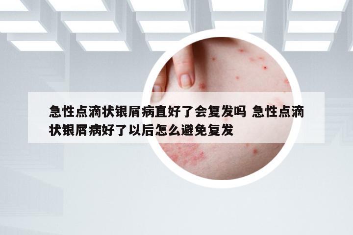 急性点滴状银屑病直好了会复发吗 急性点滴状银屑病好了以后怎么避免复发