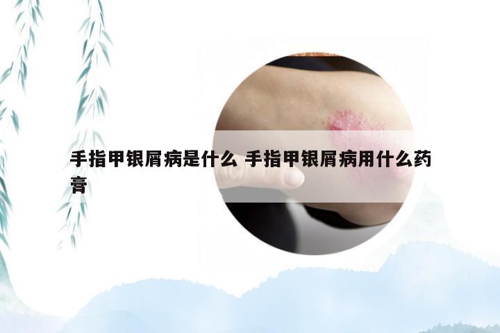 手指甲银屑病是什么 手指甲银屑病用什么药膏