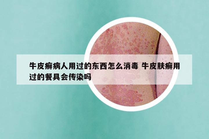 牛皮癣病人用过的东西怎么消毒 牛皮肤癣用过的餐具会传染吗