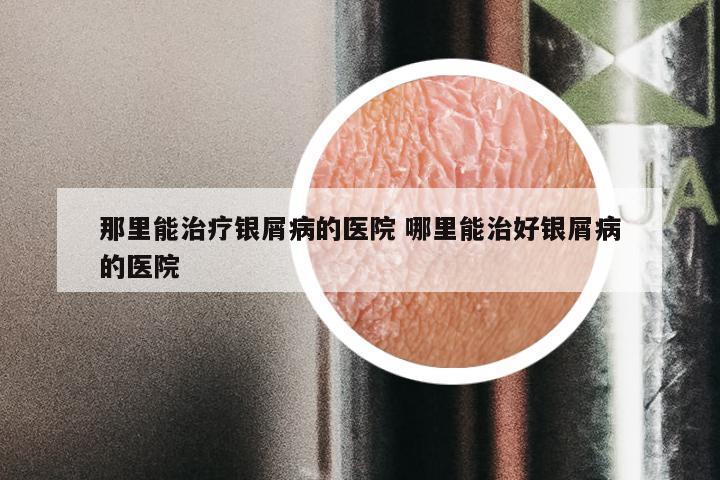 那里能治疗银屑病的医院 哪里能治好银屑病的医院