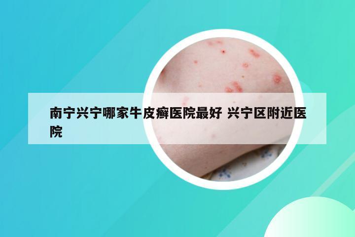 南宁兴宁哪家牛皮癣医院最好 兴宁区附近医院