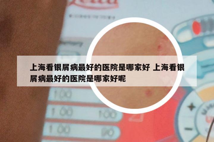 上海看银屑病最好的医院是哪家好 上海看银屑病最好的医院是哪家好呢