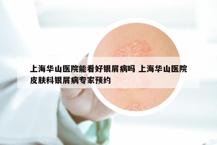 上海华山医院能看好银屑病吗 上海华山医院皮肤科银屑病专家预约