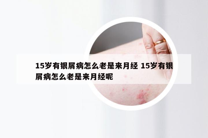 15岁有银屑病怎么老是来月经 15岁有银屑病怎么老是来月经呢