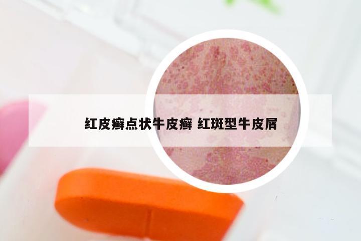红皮癣点状牛皮癣 红斑型牛皮屑