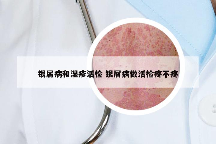 银屑病和湿疹活检 银屑病做活检疼不疼