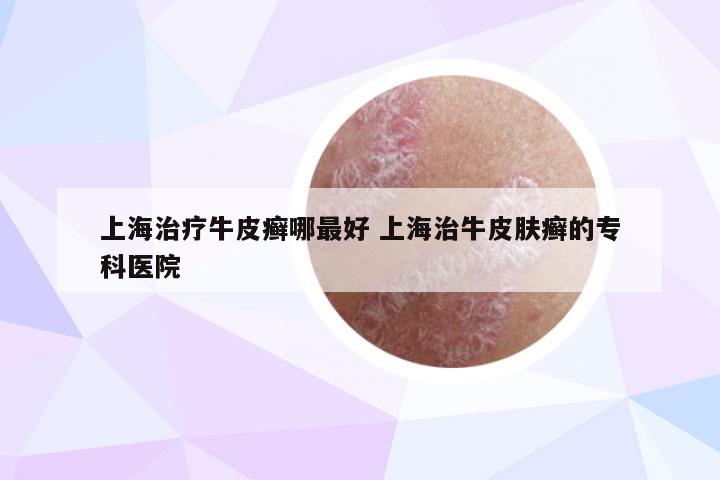 上海治疗牛皮癣哪最好 上海治牛皮肤癣的专科医院