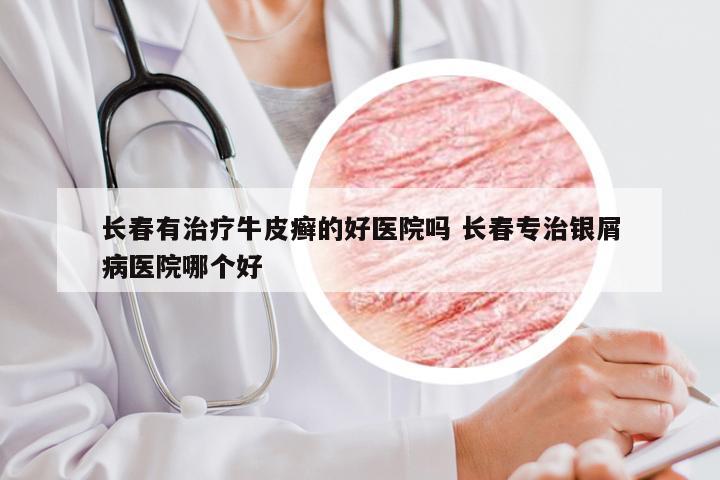长春有治疗牛皮癣的好医院吗 长春专治银屑病医院哪个好