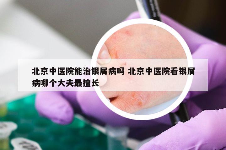 北京中医院能治银屑病吗 北京中医院看银屑病哪个大夫最擅长