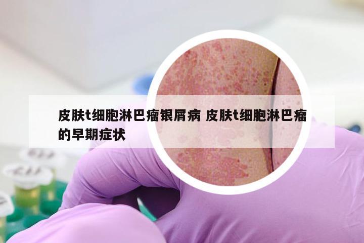 皮肤t细胞淋巴瘤银屑病 皮肤t细胞淋巴瘤的早期症状