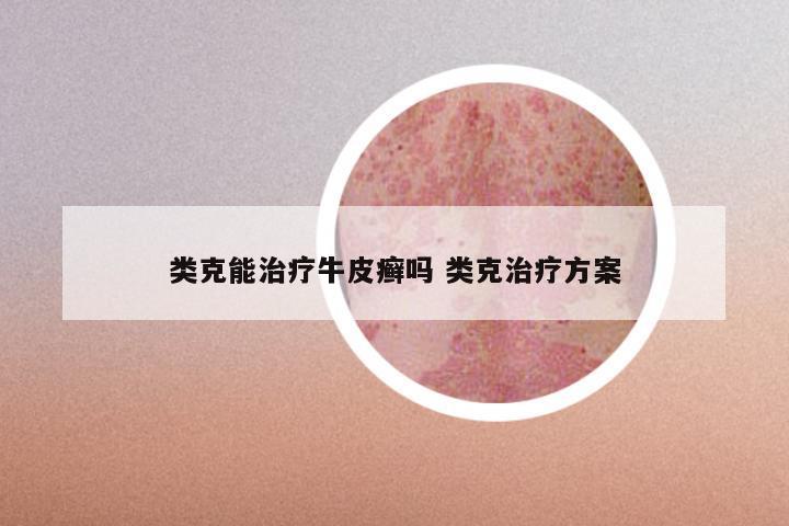 类克能治疗牛皮癣吗 类克治疗方案