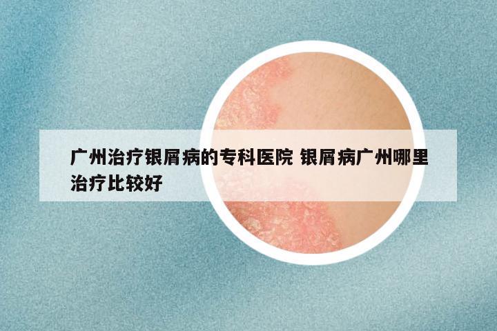 广州治疗银屑病的专科医院 银屑病广州哪里治疗比较好