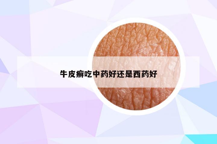 牛皮癣吃中药好还是西药好