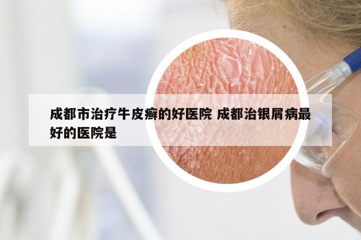 成都市治疗牛皮癣的好医院 成都治银屑病最好的医院是