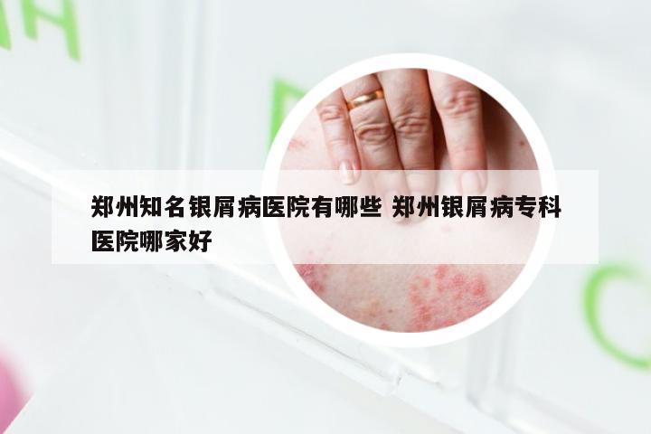 郑州知名银屑病医院有哪些 郑州银屑病专科医院哪家好