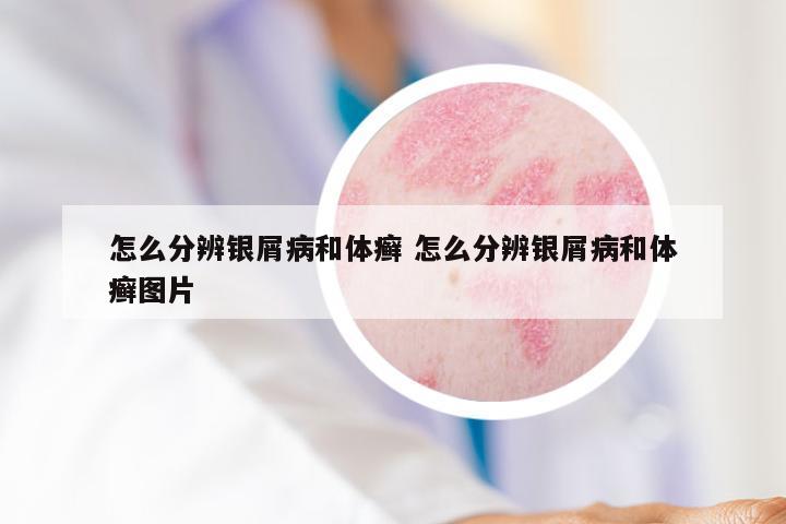 怎么分辨银屑病和体癣 怎么分辨银屑病和体癣图片
