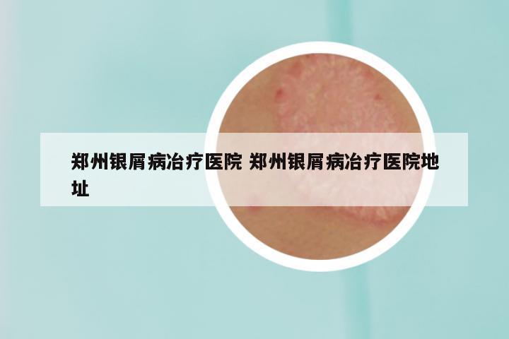 郑州银屑病冶疗医院 郑州银屑病冶疗医院地址