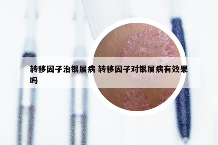 转移因子治银屑病 转移因子对银屑病有效果吗