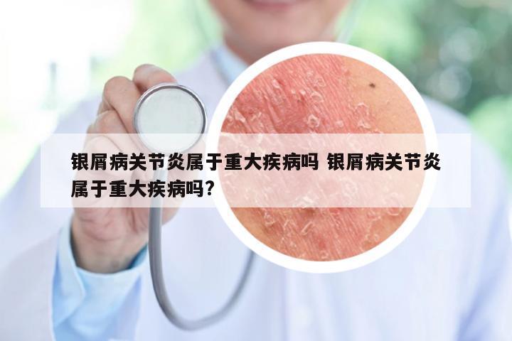 银屑病关节炎属于重大疾病吗 银屑病关节炎属于重大疾病吗?
