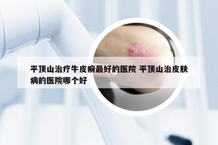 平顶山治疗牛皮癣最好的医院 平顶山治皮肤病的医院哪个好