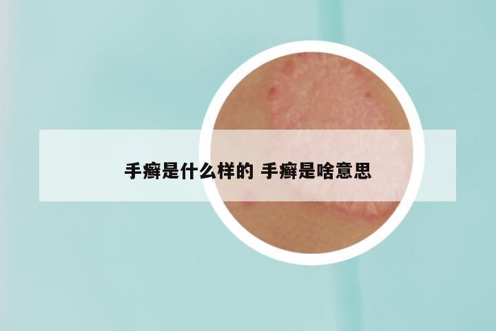 手癣是什么样的 手癣是啥意思
