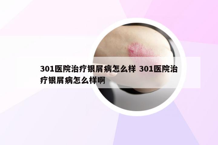 301医院治疗银屑病怎么样 301医院治疗银屑病怎么样啊