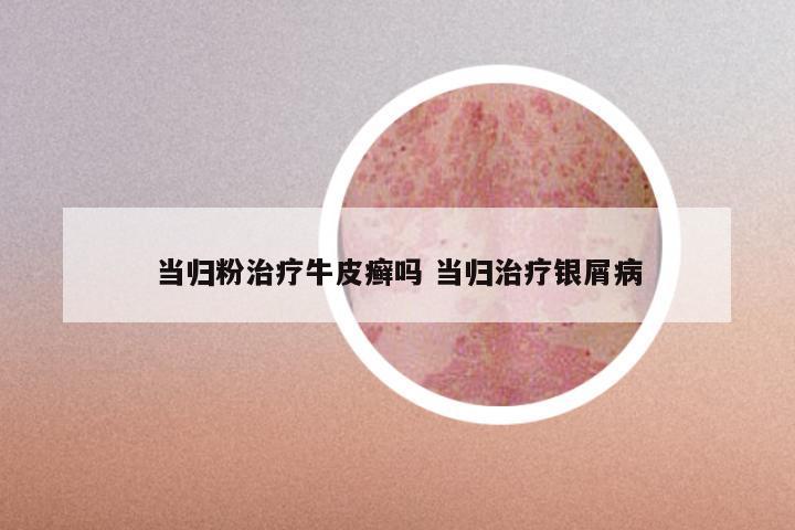 当归粉治疗牛皮癣吗 当归治疗银屑病
