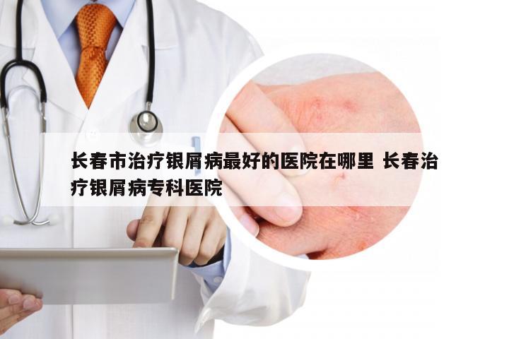 长春市治疗银屑病最好的医院在哪里 长春治疗银屑病专科医院