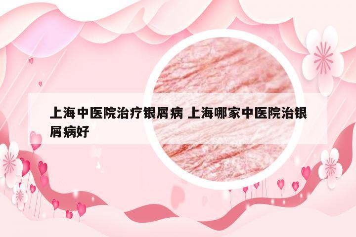 上海中医院治疗银屑病 上海哪家中医院治银屑病好