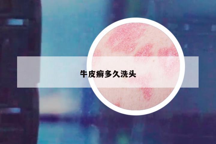 牛皮癣多久洗头