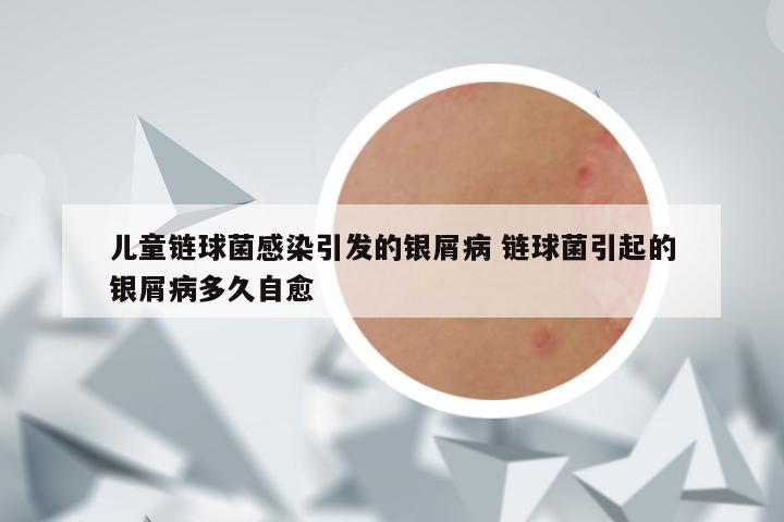 儿童链球菌感染引发的银屑病 链球菌引起的银屑病多久自愈