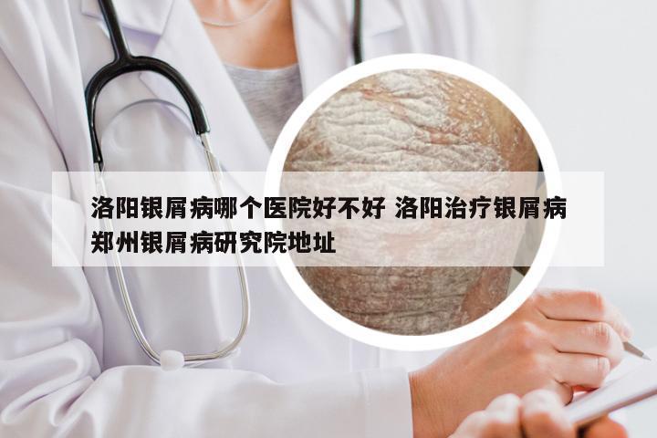 洛阳银屑病哪个医院好不好 洛阳治疗银屑病郑州银屑病研究院地址