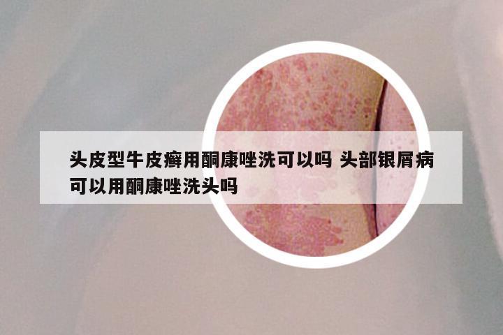 头皮型牛皮癣用酮康唑洗可以吗 头部银屑病可以用酮康唑洗头吗