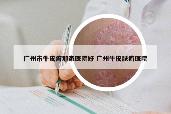 广州市牛皮癣那家医院好 广州牛皮肤癣医院