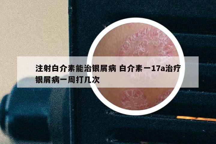 注射白介素能治银屑病 白介素一17a治疗银屑病一周打几次