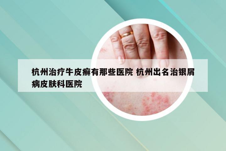 杭州治疗牛皮癣有那些医院 杭州出名治银屑病皮肤科医院