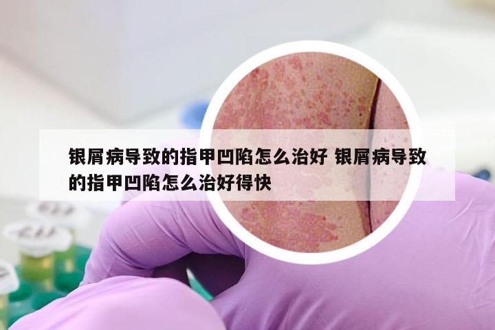 银屑病导致的指甲凹陷怎么治好 银屑病导致的指甲凹陷怎么治好得快