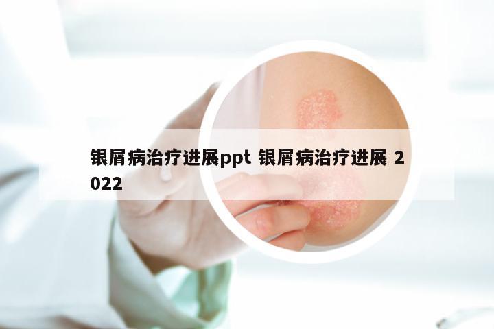 银屑病治疗进展ppt 银屑病治疗进展 2022