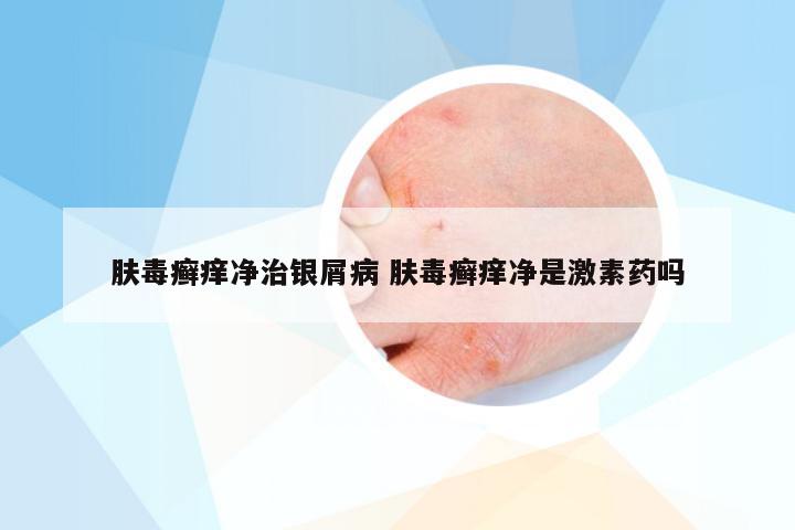 肤毒癣痒净治银屑病 肤毒癣痒净是激素药吗