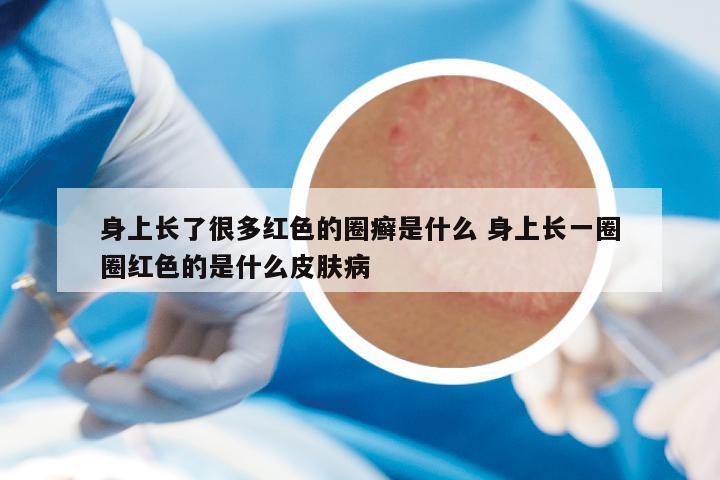 身上长了很多红色的圈癣是什么 身上长一圈圈红色的是什么皮肤病