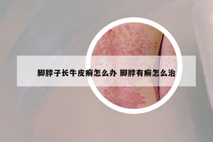 脚脖子长牛皮癣怎么办 脚脖有癣怎么治