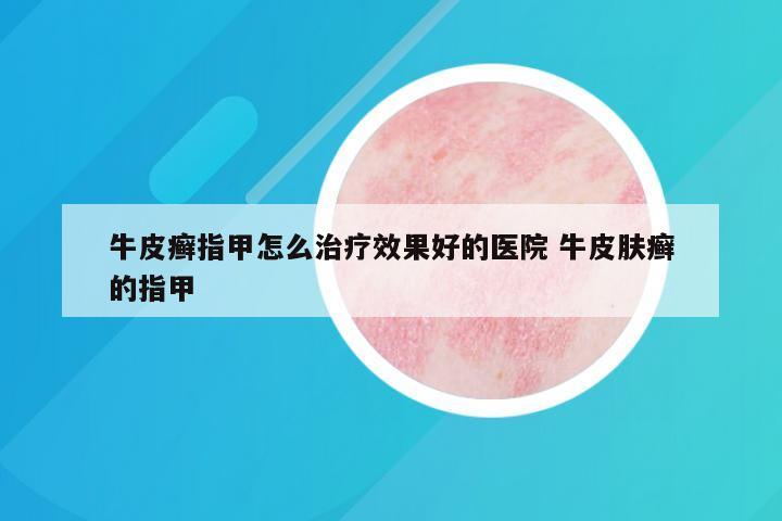 牛皮癣指甲怎么治疗效果好的医院 牛皮肤癣的指甲