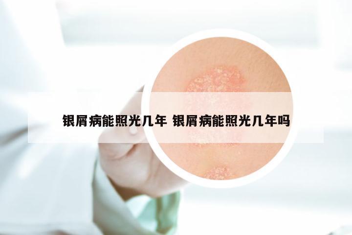 银屑病能照光几年 银屑病能照光几年吗