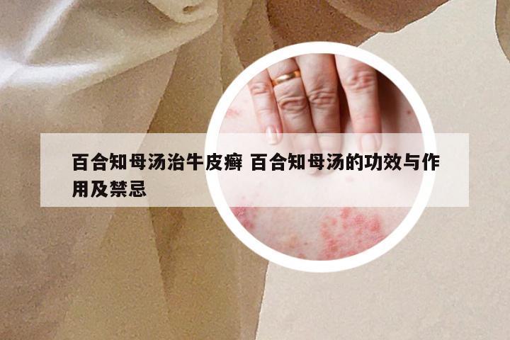 百合知母汤治牛皮癣 百合知母汤的功效与作用及禁忌