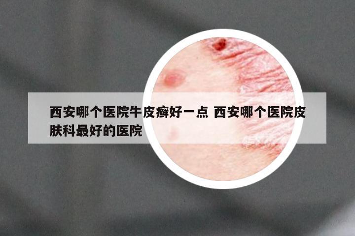 西安哪个医院牛皮癣好一点 西安哪个医院皮肤科最好的医院
