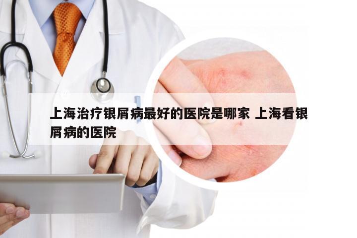 上海治疗银屑病最好的医院是哪家 上海看银屑病的医院