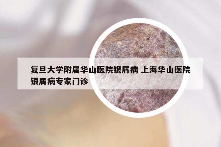 复旦大学附属华山医院银屑病 上海华山医院银屑病专家门诊